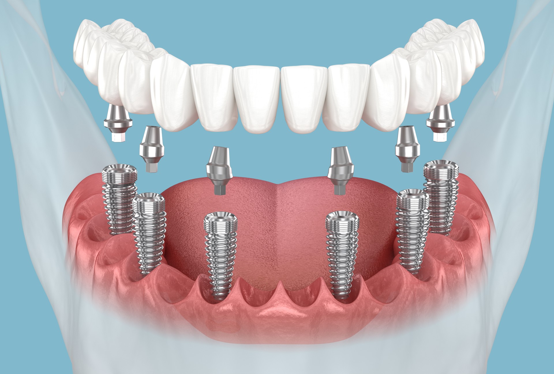 All on 6 system supported by implants in Budapest 